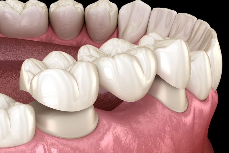 dental bridges model