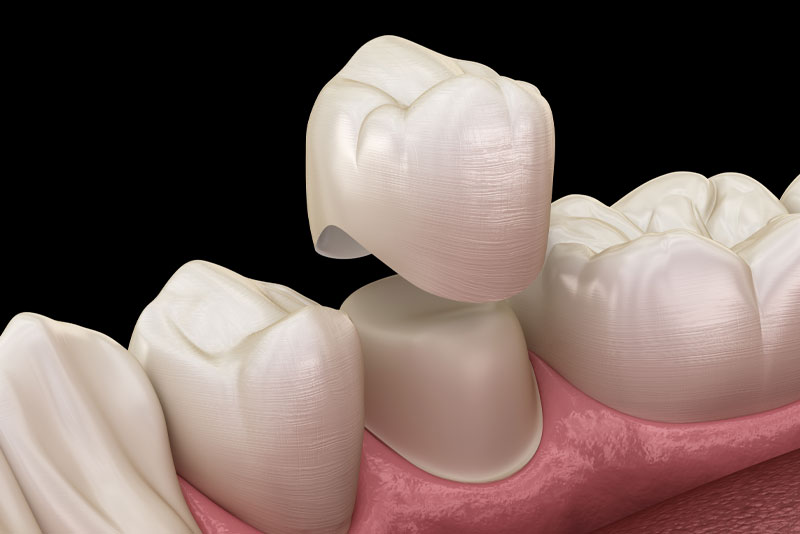 dental crown model