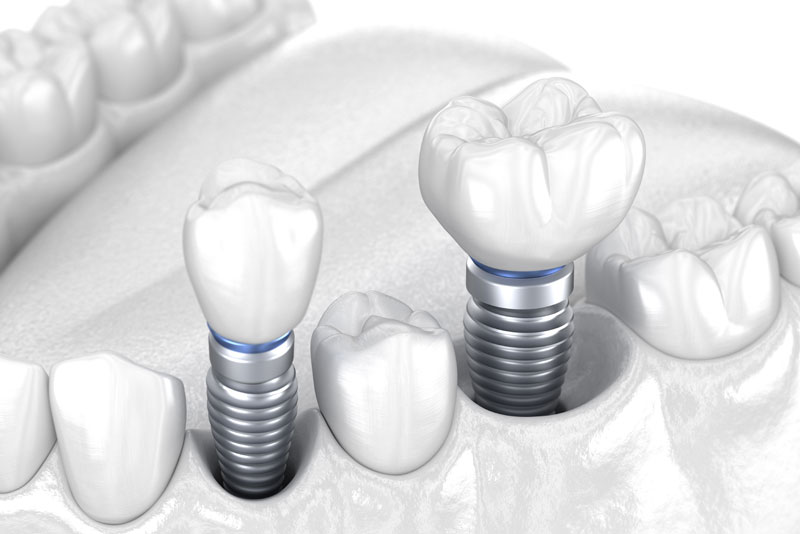 dental implants