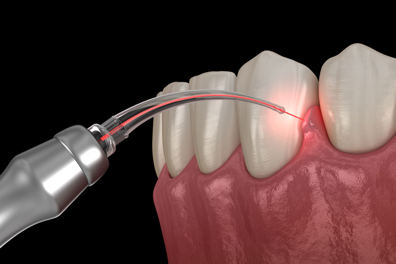 dental laser