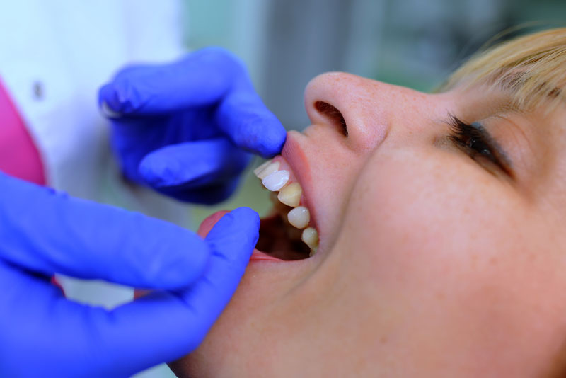 dental patient undergoing veneers procedure