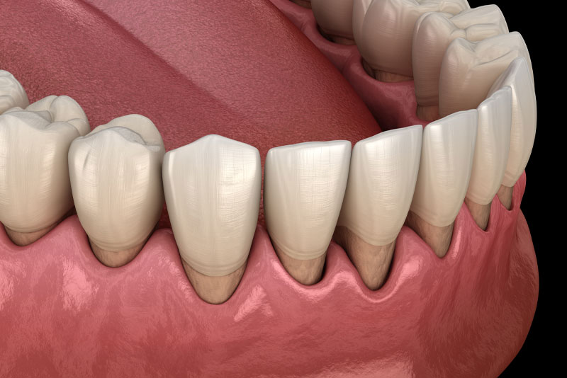 gum recession model