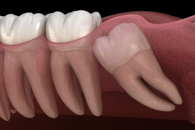 impacted wisdom teeth