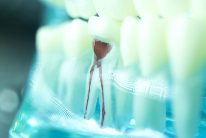 root canal model